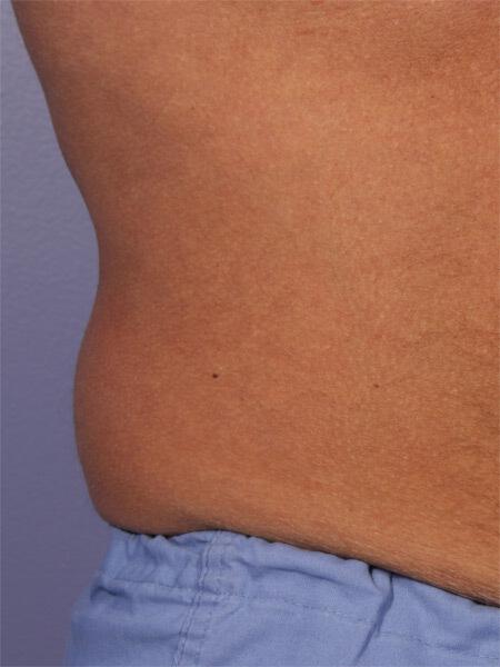 CoolSculpting Gallery Before & After Image