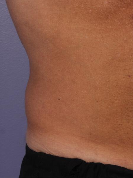 CoolSculpting Gallery Before & After Image