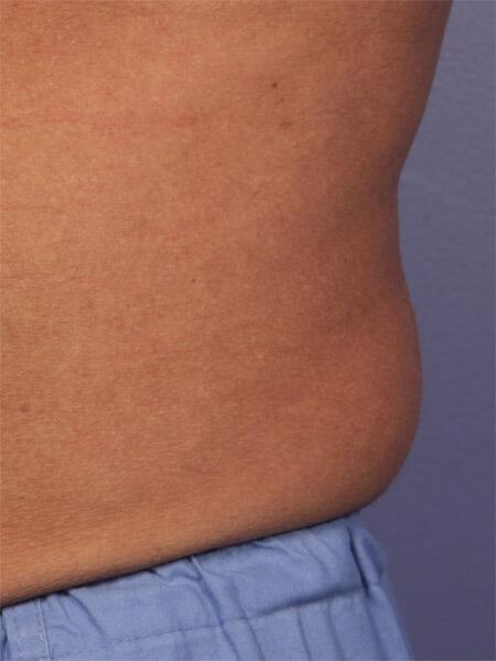 CoolSculpting Gallery Before & After Image