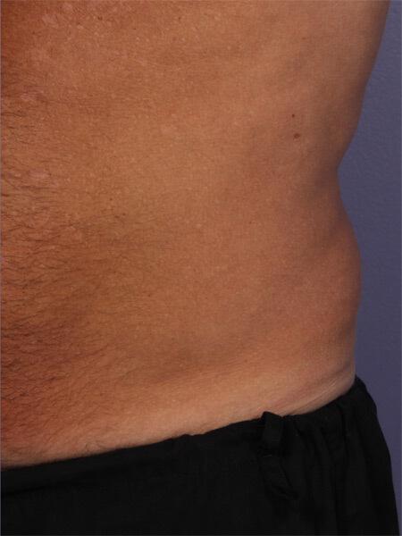 CoolSculpting Gallery Before & After Image