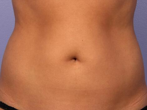 CoolSculpting Gallery Before & After Image