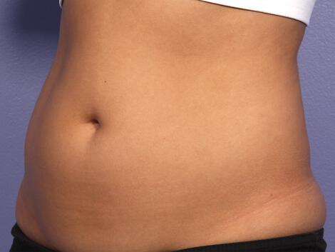 CoolSculpting Gallery Before & After Image