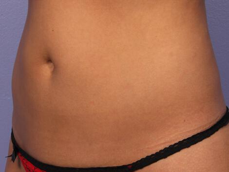 CoolSculpting Gallery Before & After Image