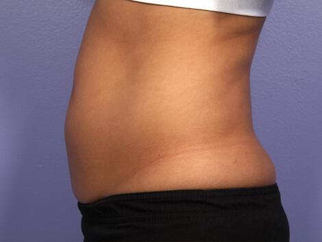 CoolSculpting Gallery Before & After Image