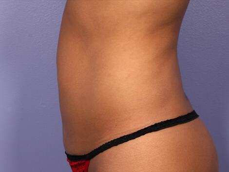 CoolSculpting Gallery Before & After Image