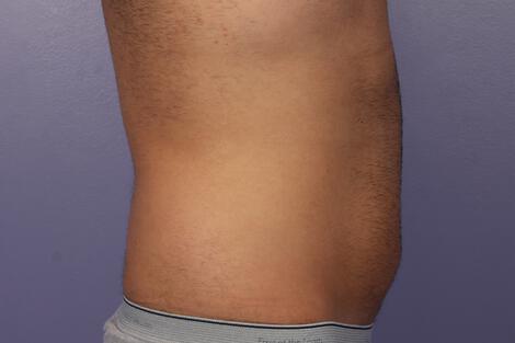 CoolSculpting Gallery Before & After Image