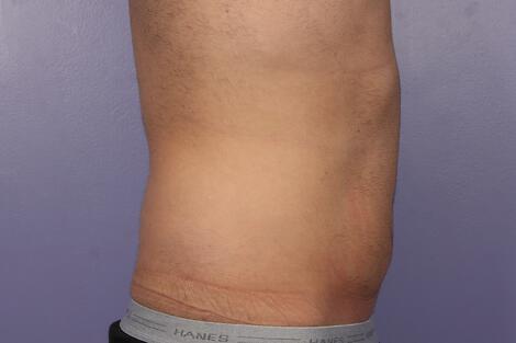 CoolSculpting Gallery Before & After Image