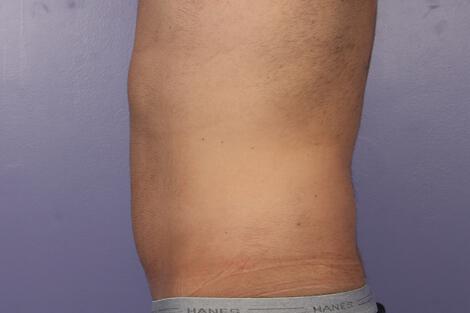 CoolSculpting Gallery Before & After Image