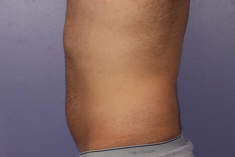 CoolSculpting Gallery Before & After Image