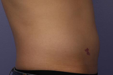 CoolSculpting Gallery Before & After Image