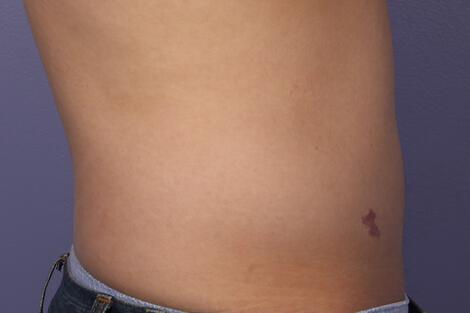 CoolSculpting Gallery Before & After Image