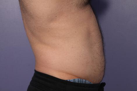 CoolSculpting Gallery Before & After Image