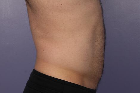 CoolSculpting Gallery Before & After Image