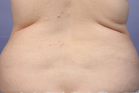 CoolSculpting Gallery Before & After Image