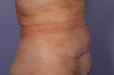 CoolSculpting Gallery Before & After Image