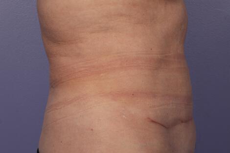 CoolSculpting Gallery Before & After Image