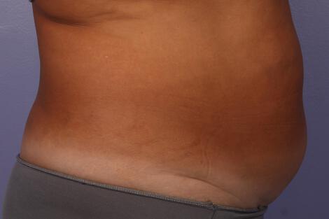 CoolSculpting Gallery Before & After Image