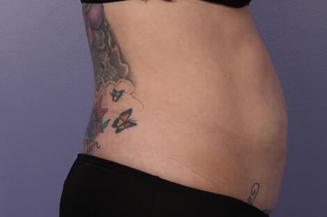 CoolSculpting Gallery Before & After Image