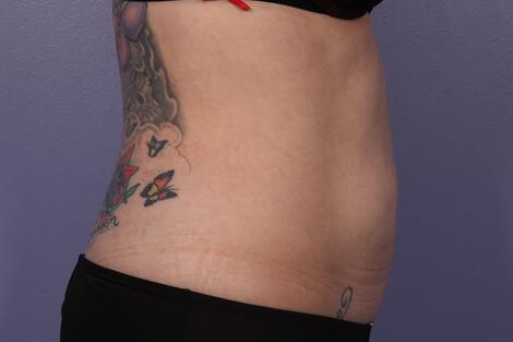 CoolSculpting Gallery Before & After Image