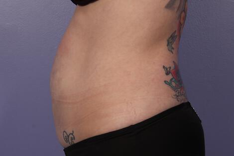 CoolSculpting Gallery Before & After Image