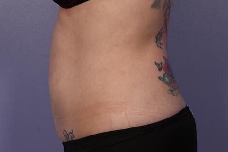 CoolSculpting Gallery Before & After Image