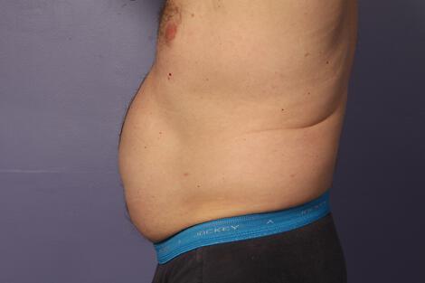 CoolSculpting Gallery Before & After Image