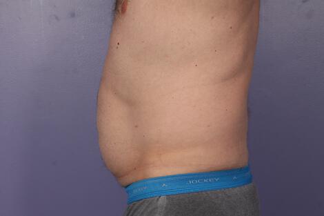 CoolSculpting Gallery Before & After Image