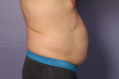 CoolSculpting Gallery Before & After Image