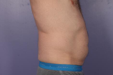 CoolSculpting Gallery Before & After Image