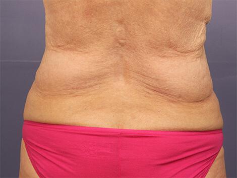 CoolSculpting Gallery Before & After Image