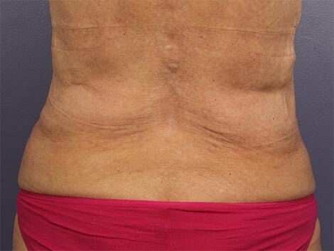 CoolSculpting Gallery Before & After Image