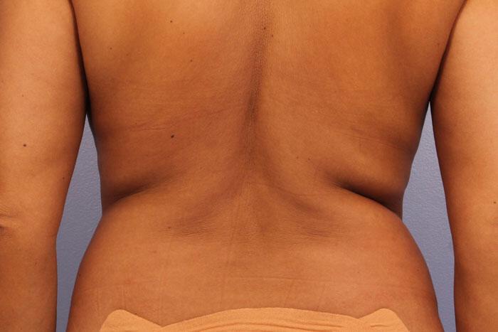 CoolSculpting Gallery Before & After Image