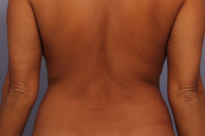 CoolSculpting Gallery Before & After Image