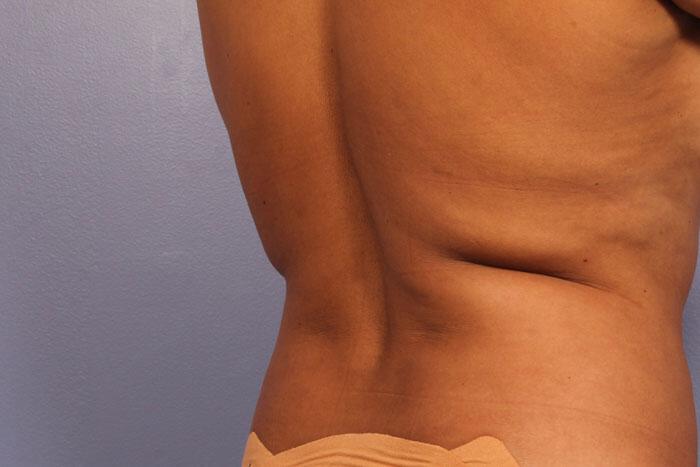 CoolSculpting Gallery Before & After Image