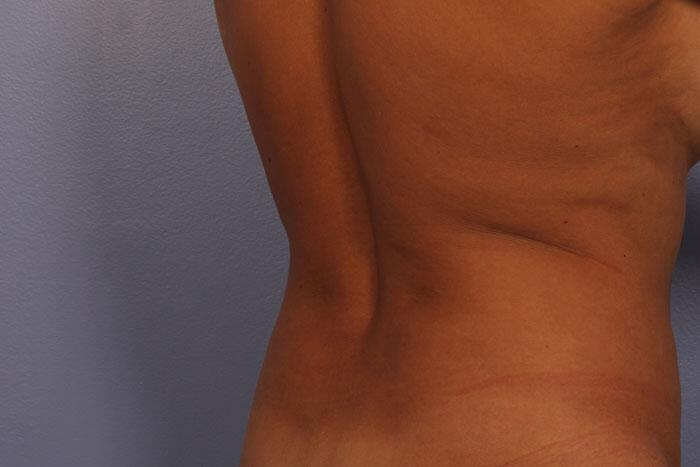 CoolSculpting Gallery Before & After Image