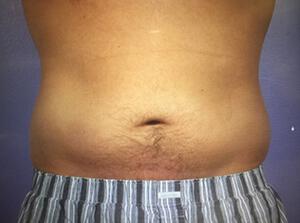 CoolSculpting Gallery Before & After Image