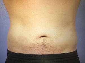 CoolSculpting Gallery Before & After Image