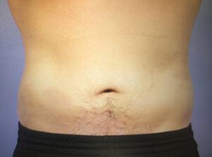 CoolSculpting Gallery Before & After Image