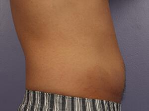 CoolSculpting Gallery Before & After Image