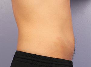 CoolSculpting Gallery Before & After Image