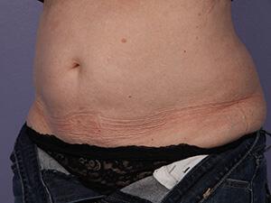 CoolSculpting Gallery Before & After Image