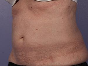 CoolSculpting Gallery Before & After Image