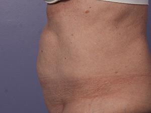 CoolSculpting Gallery Before & After Image