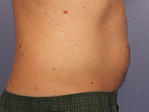 CoolSculpting Gallery Before & After Image