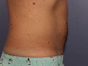 CoolSculpting Gallery Before & After Image