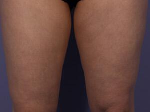 CoolSculpting Gallery Before & After Image