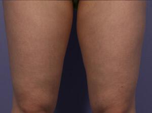 CoolSculpting Gallery Before & After Image