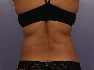 CoolSculpting Gallery Before & After Image