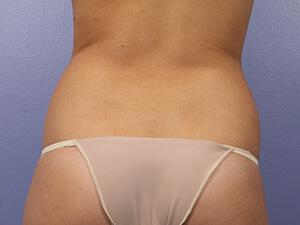 CoolSculpting Gallery Before & After Image