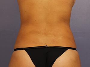 CoolSculpting Gallery Before & After Image